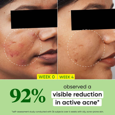 Dot & Key 2% Salicylic Acid + Cica ( Cantella) Anti Acne Serum with Zinc | Salicylic Acid Serum for Acne and Dark Spots | Serum for Oily Acne Prone Skin & Sensitive Skin | Oil-Free & Non Comedogenic | 20 ml