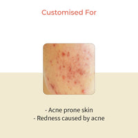 Vedix Customized Face Pack - Avasya Clarifying Clay Mask For Acne Prone Skin With Kumari + Tea Tree + Kaolin