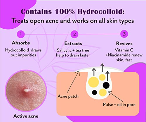 Urban Yog Acne Pimple Patch - Invisible Facial Stickers Cover With 100% Hydrocolloid, Pimple / Acne Absorbing Patch (Curvy Pimple Patch) - Pack Of 1