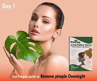 Urban Yog Face Care Combo Kit- Anti-Pigmentation Serum (30 ml) and Acne Pimple Patch (72 Dots) for and Clear Skin with 100% Hydrocolloid 10% Niacinamide | For acne and dark spots | For all skin types