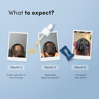 Man Matters Stage 2 Hair Fall Kit | Minoxidil with Procapil 60ml with Biotin Hair Gummies 30N | Stimulates Hair Follicles, Nourishes Hair & Promotes Hair Growth