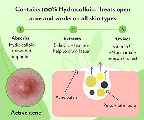 Urban yog Acne Pimple Patch - 72 Invisible Facial Stickers cover with 100% Hydrocolloid (Acne Pimple Patch (Pack of 2))