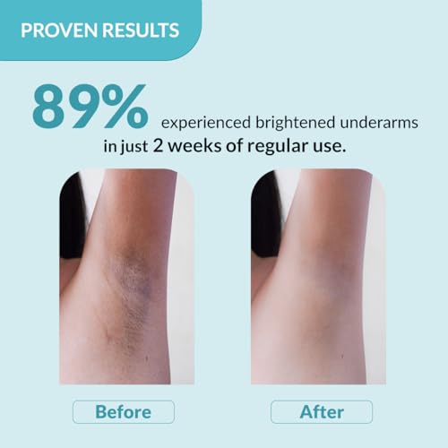 Fixderma Nigrifix Underarm Roll on with 6% AHA, Lactic Acid & 1% Mandelic Acid & Kojic Acid | Brightens Skin & Exfoliates Underarm | For All Skin Type, Men & Women - 60ml