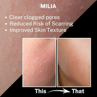 HOUSE OF BEAUTY Milia Serum with Azelaic Acid, Niacinamide, Salicylic Acid for Whiteheads, Bumps and Milia, Face, Healthy Skin (15ml, Pack of 1)