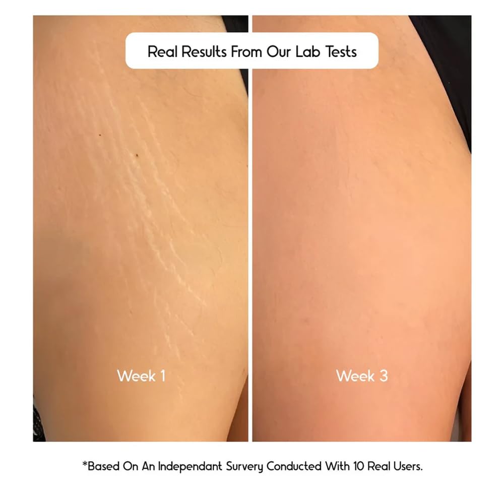 Cos-IQ Stretch Marks Removal Roll-On Serum (Pack of 3 X 40ml Each) | with Striover | Scar Removal | Uneven Skin Tone | All Skin Types | 120ml