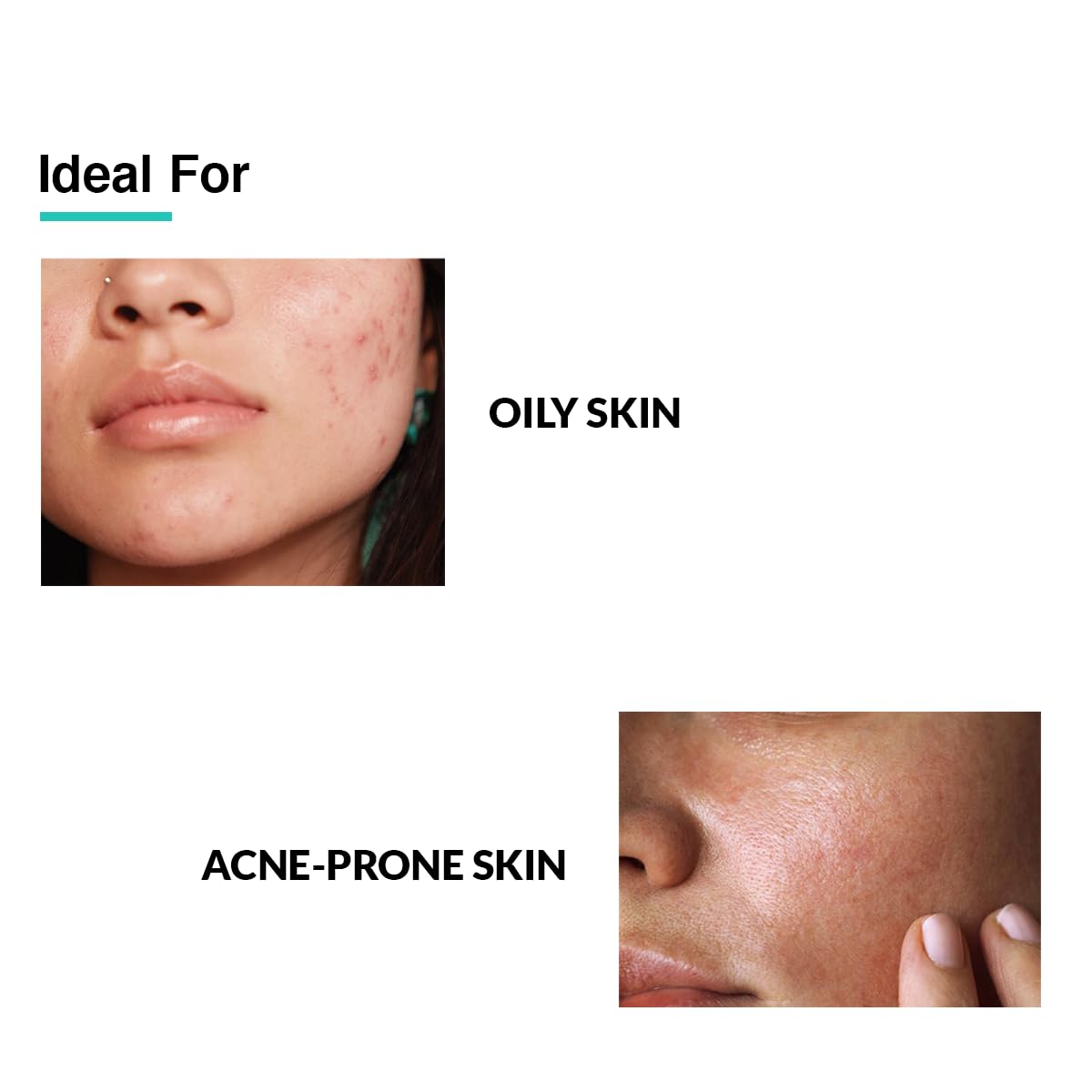 Fixderma 2% Salicylic Acid Serum for Anti Acne & Spot Treatment with 5% Azelaic Acid & 4% Mandelic Acid | Anti Acne Face Serum | Face Serum for Men & Women | Face Serum for Oily Skin - 15g…