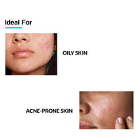 Fixderma 2% Salicylic Acid Serum for Anti Acne & Spot Treatment with 5% Azelaic Acid & 4% Mandelic Acid | Anti Acne Face Serum | Face Serum for Men & Women | Face Serum for Oily Skin - 15g…