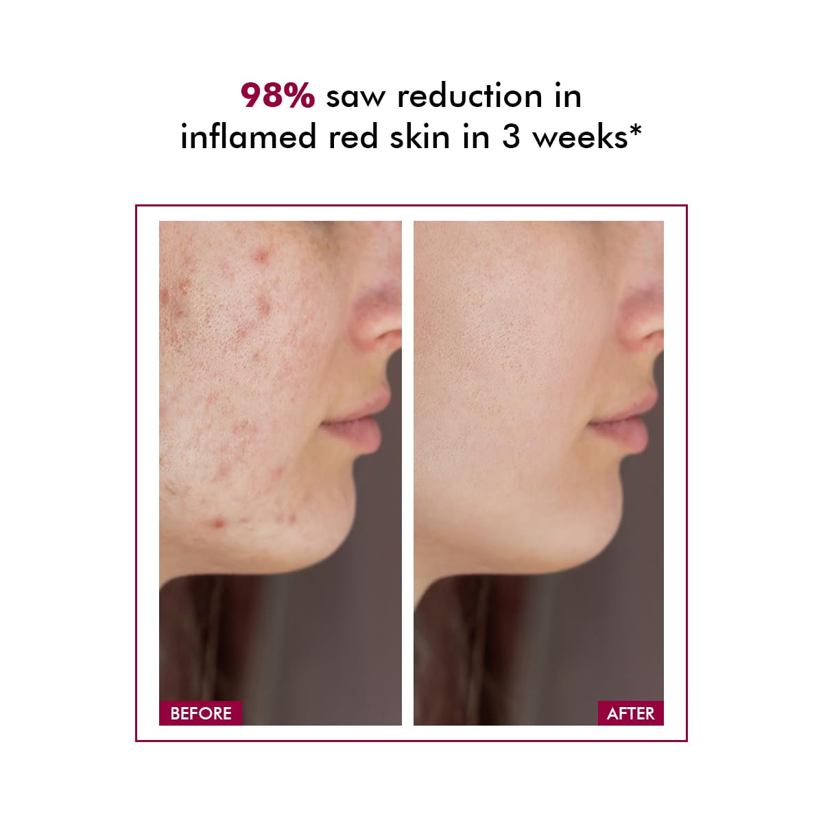 Conscious Chemist® 10% Azelaic Acid Cream | 50g | Face Cream for Men & Women, Moisturizer for Acne Prone Skin, Redness Relief, Soothe Irritation & Inflammation, All Skin Types - Azicalm