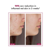 Conscious Chemist® 10% Azelaic Acid Cream | 50g | Face Cream for Men & Women, Moisturizer for Acne Prone Skin, Redness Relief, Soothe Irritation & Inflammation, All Skin Types - Azicalm