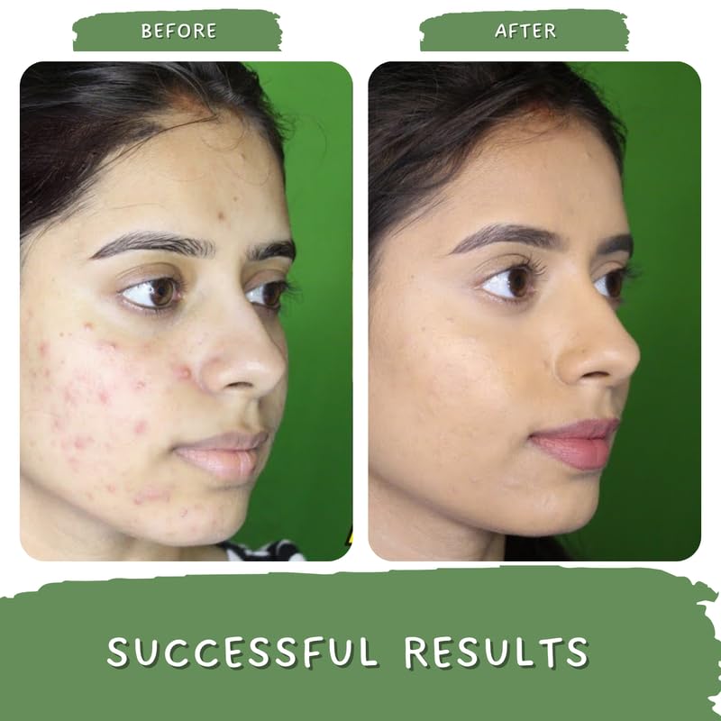 Mystiq Living Green Tea Clarity with 2% Salicyclic Acid Gel Cream for Anti Acne, Pimples & Scar Removal - 50GM | Skin Clarifying Day & Night Gel | Moisturizer for Oily & Acne Prone Skin
