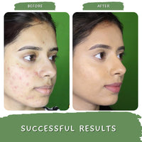 Mystiq Living Green Tea Clarity with 2% Salicyclic Acid Gel Cream for Anti Acne, Pimples & Scar Removal - 50GM | Skin Clarifying Day & Night Gel | Moisturizer for Oily & Acne Prone Skin