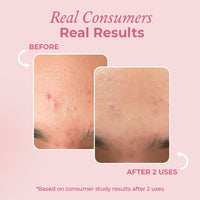 The Pink Foundry Acne Spot Corrector with Salicylic Acid & Sulfur for Active Acne, Blackheads & Whiteheads | Reduce pimple with overnight use | All Skin Types | Dermatologically Tested | 15ml