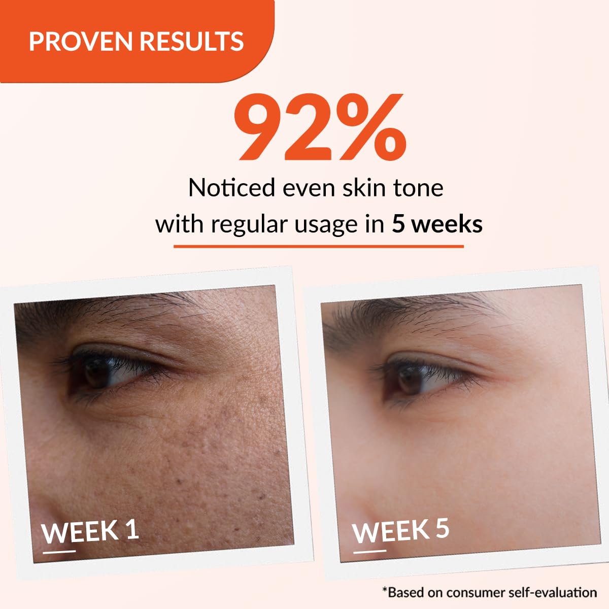 Fixderma Tranexamic Acid + 2% Kojic Acid + 1% Arbutin SKARFIX -TX Face Cream | Pigmentation Removal Cream | Kojic Acid Cream | Uneven Skin Tone - 15 gm (Pack of 1)