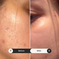 Mul Secrets 100 ml Revive Acne Facemask & Scrub | Acne Reduction, Acne Scar, Sebum Control, Helps Control Skin Oiliness & Dark Spots & Pimples | Manjistha, Aloe Vera, Salicylic acid 2% (30+ Uses)