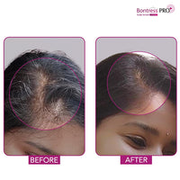 Bontress PRO+ Scalp Serum Fortified with Redensyl, Anagain, Capixyl,Procapil | Hair Serum for Hair Growth & Hair Fall 60ml