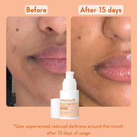 WishCare Super Bright C16 Vitamin C Serum for Oily Skin, Dry & Combination Skin -10% Vitamin C, 4% Niacinamide,1% Kojic Acid, 0.5% Ferulic Acid, Licorice & 4-n-BR- Serum For Pigmentation & Dark Spots 30ml