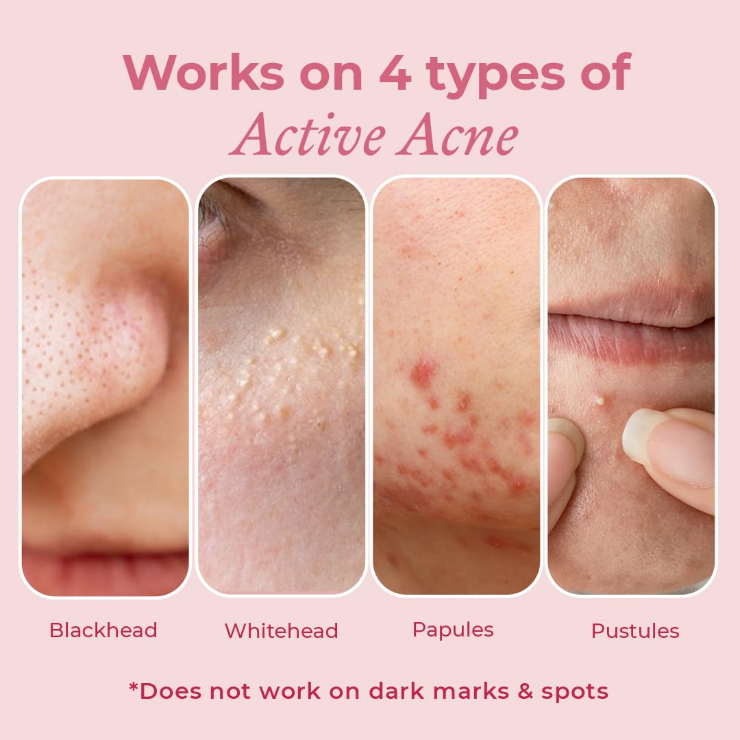 The Pink Foundry Acne Spot Corrector with Salicylic Acid & Sulfur for Active Acne, Blackheads & Whiteheads | Reduce pimple with overnight use | All Skin Types | Dermatologically Tested | 15ml