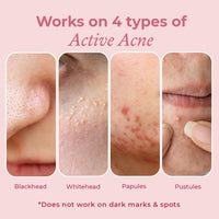 The Pink Foundry Acne Spot Corrector with Salicylic Acid & Sulfur for Active Acne, Blackheads & Whiteheads | Reduce pimple with overnight use | All Skin Types | Dermatologically Tested | 15ml