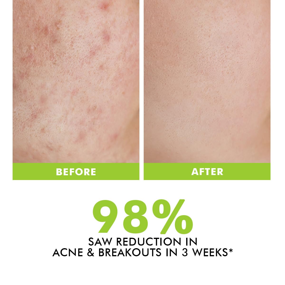 Conscious Chemist® 2% Salicylic Acid Cream | 50g | Acne Spot Corrector | Moisturizer for Oily Acne Prone Skin, Face Cream for Men & Women, Overnight Acne & Oil Control, Itchiness & Redness, Non greasy Gel Cream - Flashfix