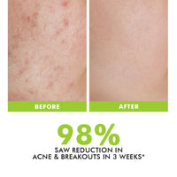 Conscious Chemist® 2% Salicylic Acid Cream | 50g | Acne Spot Corrector | Moisturizer for Oily Acne Prone Skin, Face Cream for Men & Women, Overnight Acne & Oil Control, Itchiness & Redness, Non greasy Gel Cream - Flashfix
