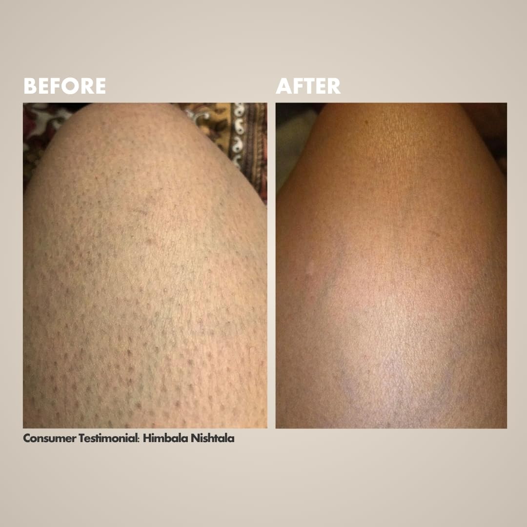 Hibiscus Monkey Ingrown Hair Treatment | 100% Plant Derived | Reduces Ingrown Hair, Soothes Razor Burns, Prevent Acne Breakout Post-Shaving or Waxing | Reduce Skin Irritation | Jojoba, Almond, Tamanu, Plant Salicylic (1%) | Dermatologist Tested