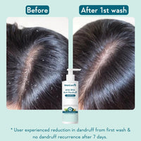 WishCare Hydrating AHA BHA Anti Dandruff Shampoo For Women & Men- Piroctone Olamine, Salicylic Acid, LHA, Climbazole, Pre+Probiotics & Hyaluronic Acid - Paraben & Sulphate Free Shampoo 250ml