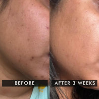 Conscious Chemist Kojic Acid Face Cream | 20g | Azelaic Acid Cream, Face Cream for Men & Women, Niacinamide & Tranexamic Acid, Anti Pigmentation Cream, Reduce Dark Spots, All Skin Type - Trubiom