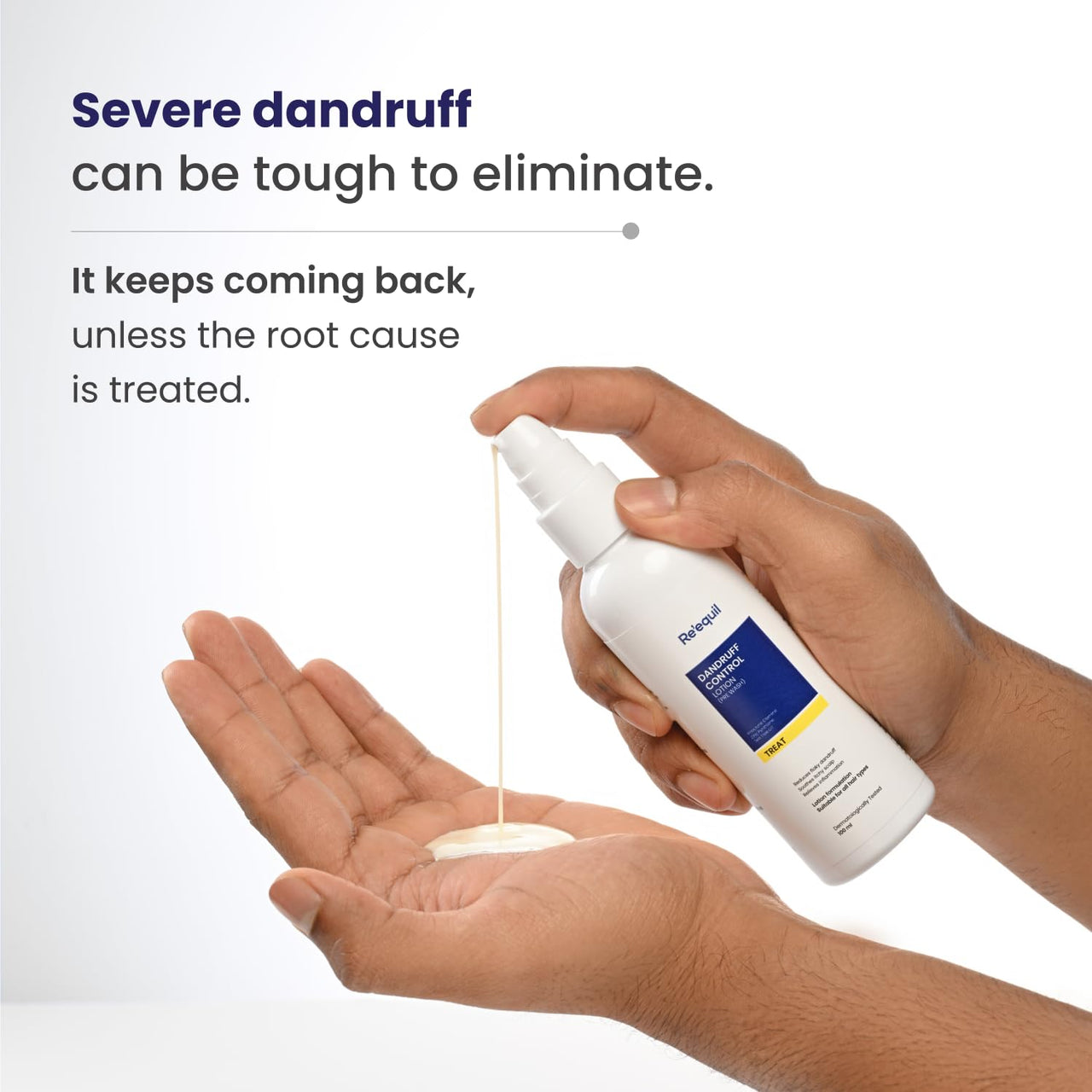 RE' EQUIL Dandruff Control Lotion (Pre Wash) | Reduces Severe, Greasy, And Flaky Dandruff | Reduces Dryness & Itching | No Drip Formulation | All Hair Types | 100Ml