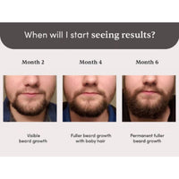 Man Matters Beardmax Growth Serum 30ml | 5% Minoxidil | Activates Beard Follicles | Solves Uneven & Patchy Beard | Alcohol Free
