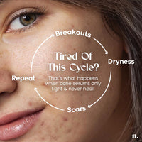 Numour No Breakouts Tonight| Dual Acne face Serum 20ml | 8% Actives 2% Encapsulated Salicylic + 4% Niacinamide + Azelaic Acid & Zinc | Acne‑Prone & Sensitive Skin