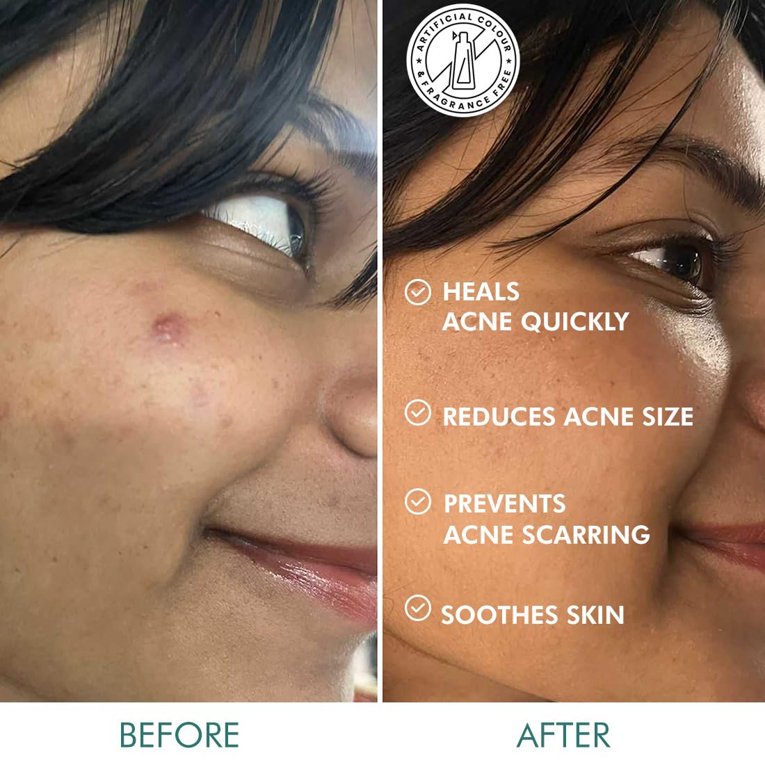 mCaffeine Matcha Tea Hydrocolloid Acne Patches with 0.5% Salicylic Acid | Invisible Waterproof Patches for Active Acne & Pimples | Reduces Acne Size in 2 Uses | for both Women and Men | All Skin Types - 3 Sizes (24N x1)
