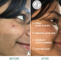 mCaffeine Matcha Tea Hydrocolloid Acne Patches with 0.5% Salicylic Acid | Invisible Waterproof Patches for Active Acne & Pimples | Reduces Acne Size in 2 Uses | for both Women and Men | All Skin Types - 3 Sizes (24N x1)
