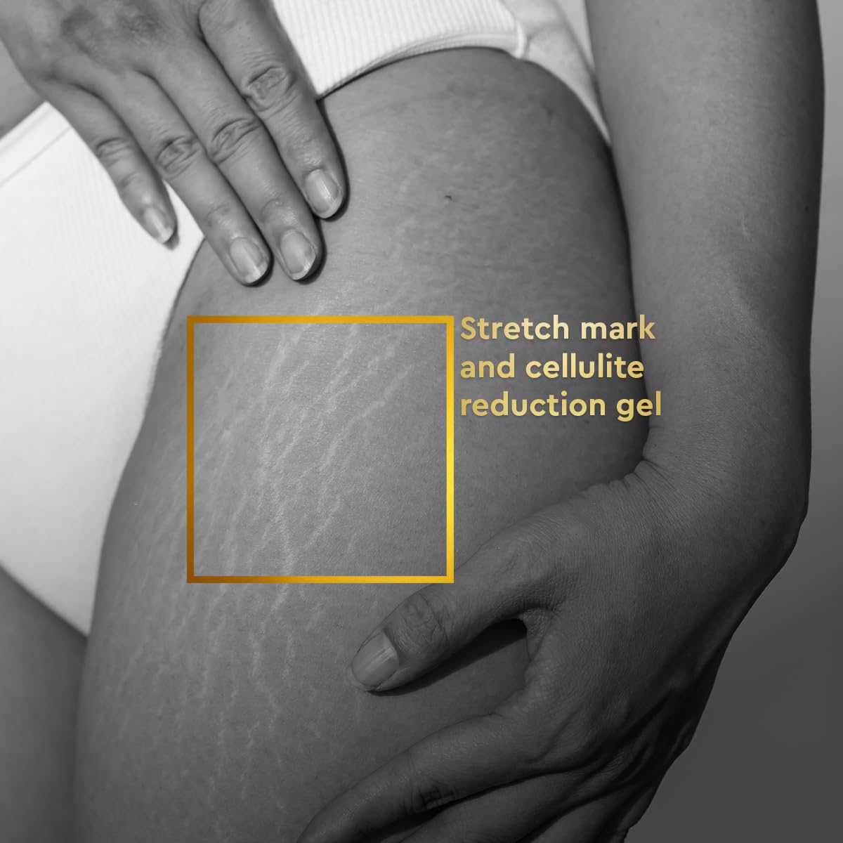 VLCC Clinic Anti-Stretch Mark Cream - 100ml | Cellulite & Stretch Mark Reduction Cream | Easy Absorption | Helps Fade Stretch Marks and Brighten Skin | Dermatologically Tested