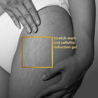 VLCC Clinic Anti-Stretch Mark Cream - 100ml | Cellulite & Stretch Mark Reduction Cream | Easy Absorption | Helps Fade Stretch Marks and Brighten Skin | Dermatologically Tested