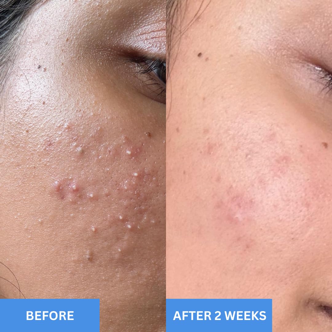 Mayskin Daily Dew Moisturizer | 4% Niacinamide + Bakuchiol + 14 Botanical Extracts | Hydrates, Balances & Brightens Skin | Controls Oil, Fades Marks & Strengthens Skin Barrier | Lightweight Gel Texture | Suitable for All Skin Types | Dermatologist Tested