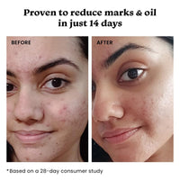 Foxtale Oil Control Duo | 12% Niacinamide Clarifying Serum + Oil Balancing Moisturizer | Targets 7 Signs of Acne | Oil-Free Glow, Smoother Texture | With Azelaic Acid, Niacinamide & Cica
