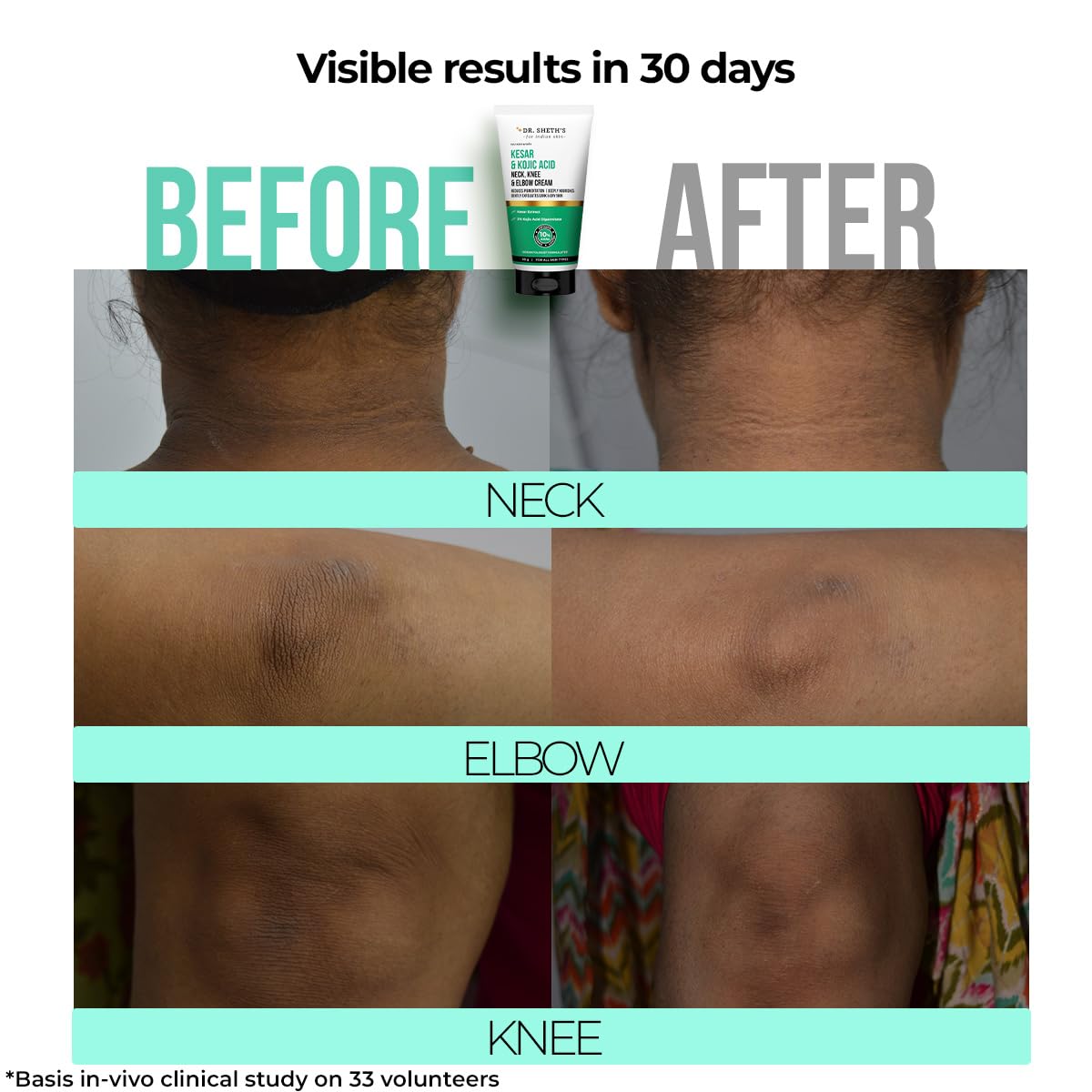 Dr. Sheth's Kesar & Kojic Acid Neck, Knee & Elbow Cream | Clinically Tested | Helps To Reduce Pigmentation | 10% AHAs+2% Kojic Acid+Urea | For Dark Neck, Ankles, Knuckles, Knees, Thighs & Elbows | 50g