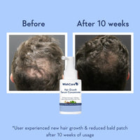 WishCare Hair Growth Serum Concentrate - 3% Redensyl, 4% Anagain, 2% Baicapil, Caffeine, Biotin & Rice Water - Advanced Hair Growth Serum for Hair Fall Control & Hair Growth 30ml