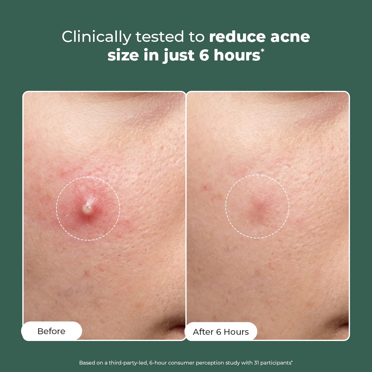 Conscious Chemist® Rapid Relief Acne Spot Corrector Gel | 15g | Triple-Action Treatment with 2% Salicylic Acid & Azelaic Acid | Clears Pimples, Reduces Redness & Fades Dark Spots | For Men & Women