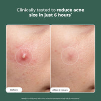 Conscious Chemist® Rapid Relief Acne Spot Corrector Gel | 15g | Triple-Action Treatment with 2% Salicylic Acid & Azelaic Acid | Clears Pimples, Reduces Redness & Fades Dark Spots | For Men & Women