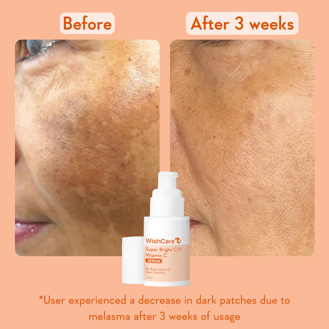 WishCare Super Bright C16 Vitamin C Serum for Oily Skin, Dry & Combination Skin -10% Vitamin C, 4% Niacinamide,1% Kojic Acid, 0.5% Ferulic Acid, Licorice & 4-n-BR- Serum For Pigmentation & Dark Spots 30ml
