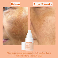 WishCare Super Bright C16 Vitamin C Serum for Oily Skin, Dry & Combination Skin -10% Vitamin C, 4% Niacinamide,1% Kojic Acid, 0.5% Ferulic Acid, Licorice & 4-n-BR- Serum For Pigmentation & Dark Spots 30ml