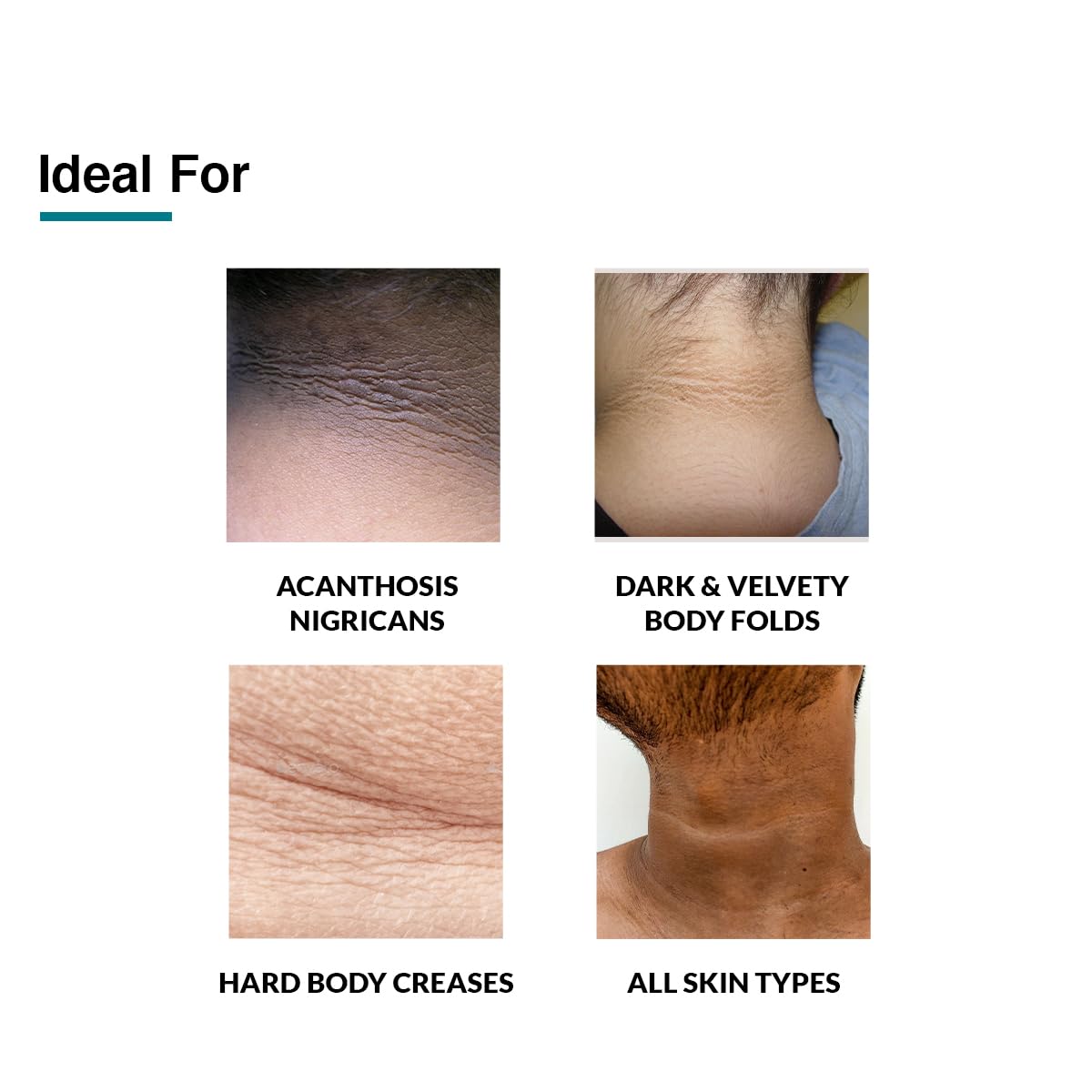 Fixderma Nigrifix Cream for Acanthosis Nigricans with Lactic Acid For Body Parts like Neck, Ankles, Knuckles, Armpits, Thighs & Elbows | Exfoliant 100 gm (Pack of 1)