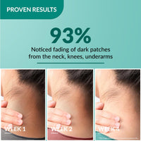 Nigrifix Cream For Dark Body Parts like Neck, Ankles, Knuckles, Armpits and Elbows - 50g