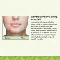 Indus Valley Calming Acne Gel 30ml