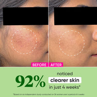 Dot & Key Niacinamide + CICA (Centella) Oil Free Moisturizer for Acne Prone Skin | Oil Free & Lightweight | Fades Dark Spots & Blemishes, Soothes Redness | Acne Cream | For Oily Acne Prone & Sensitive Skin | 50gm