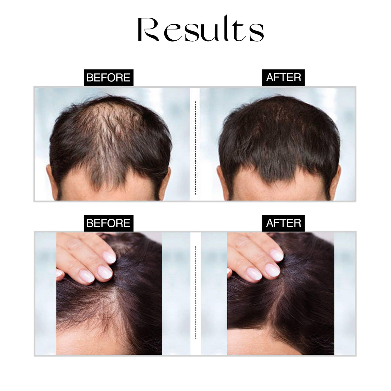 Nourish Mantra Advanced Hair Growth Serum/For Women & Men/Made With Redensyl, Anagain, Procapil & Rice Water/for Hair Fall/Hair Thinning & for All Hair Types (50 ml)
