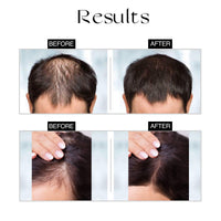 Nourish Mantra Advanced Hair Growth Serum/For Women & Men/Made With Redensyl, Anagain, Procapil & Rice Water/for Hair Fall/Hair Thinning & for All Hair Types (50 ml)