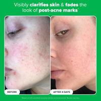 Paula's Choice BOOST 10% Azelaic Acid Booster Cream Gel Face Serum with Salicylic Acid, Oil-Free Skin Brightening Serum for Face, Fragrance-Free - 5 ml