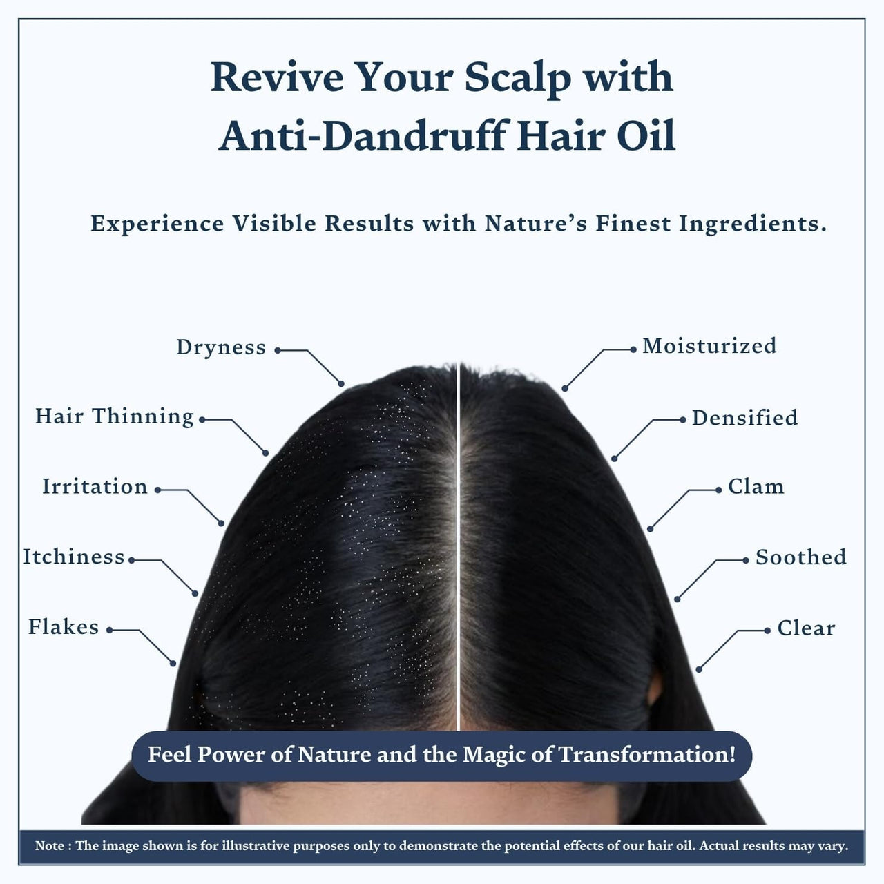 Singular Anti Dandruff Hair Oil for Men & Women - Pure & Natural Cold Pressed Hair oil for Dandruff and Hairfall for Scalp Microbiome Balance with Tea Tree, Peppermint & More Hair Oil - 200 ml